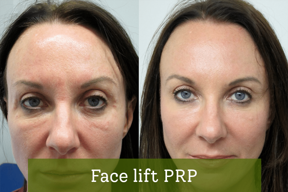 Face lift PRP - Rainforest Medspa